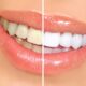 Tipos-de-clareamento-dental-1536x1098